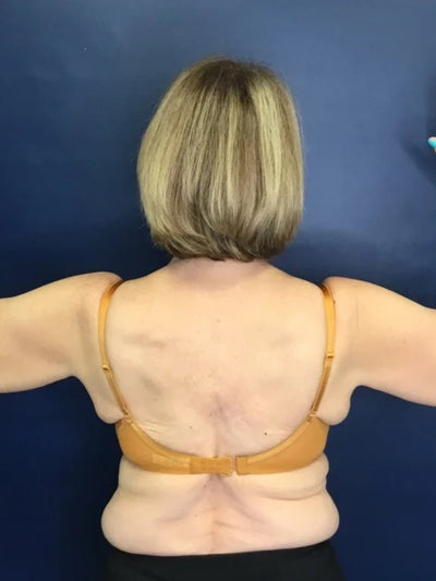 bodytite 3 - Before