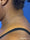 bodytite 5 - After