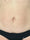 bodytite 7 - After