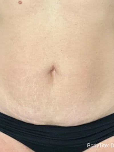 bodytite 7 - After