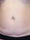 bodytite 7 - Before