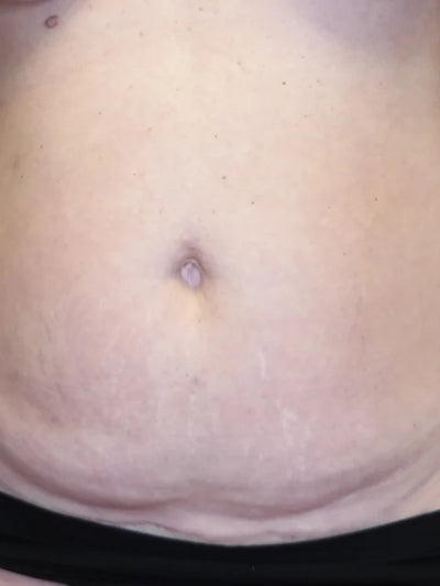 bodytite 7 - Before