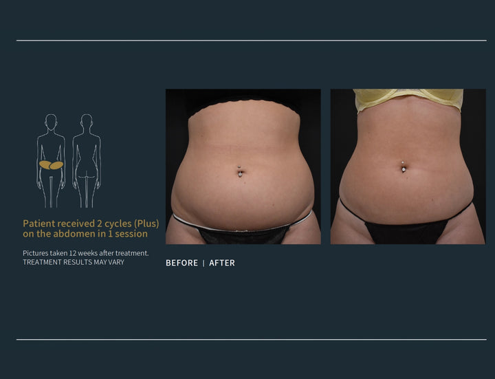 Coolsculpting Elite