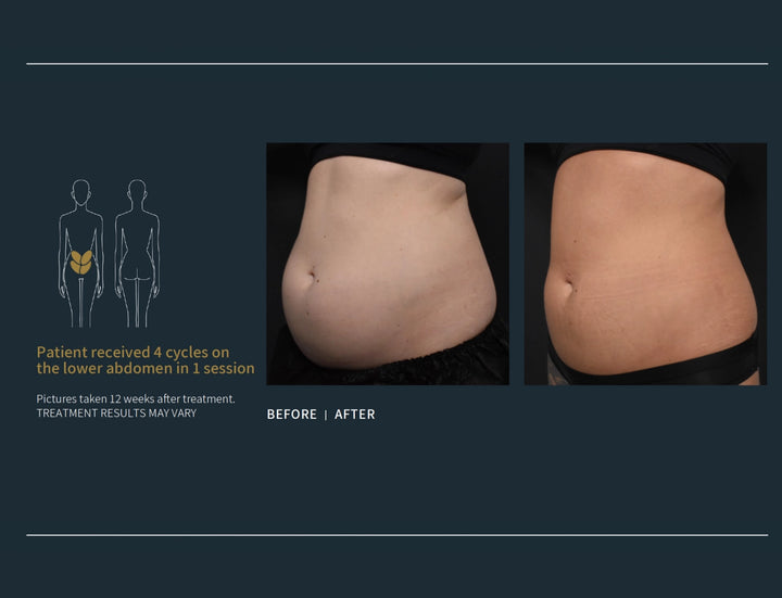 Coolsculpting Elite