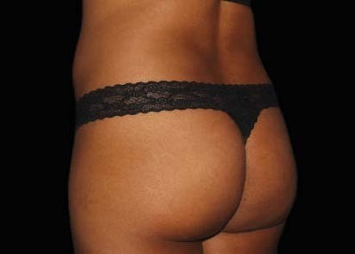 emsculpt 3 - Before