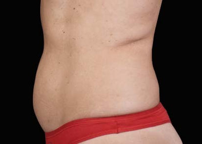 emsculpt 2 - After