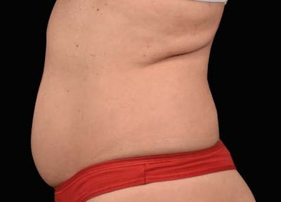 emsculpt 2 - Before