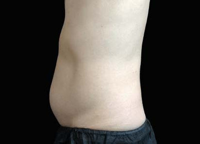 emsculpt - After