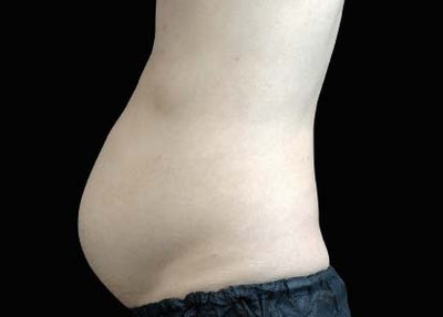 emsculpt - Before