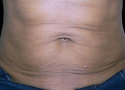 exilis - Before