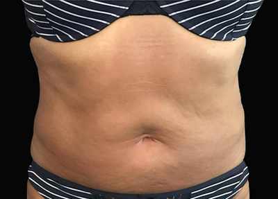 exilis 2 - After