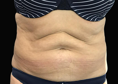 exilis 2 - Before