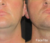 FaceTite Radiofrequency Non-Surgical Facelift