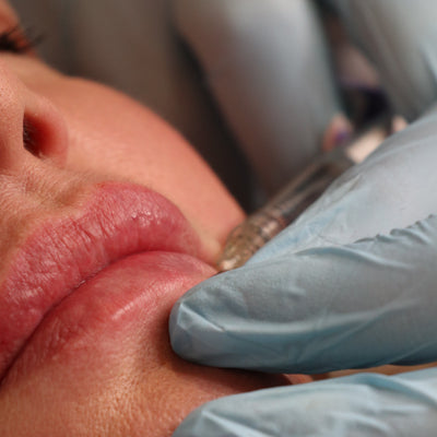 Dermal Lip Filler