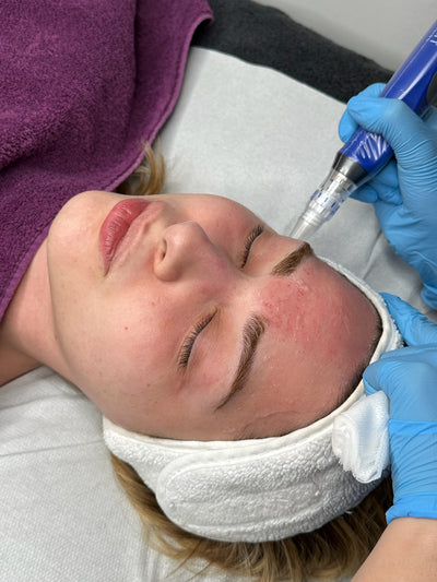 Skinpen Microneedling