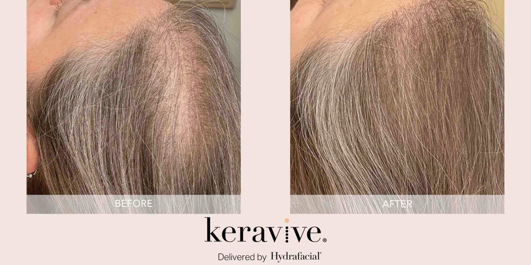 Hydrafacial Keravive