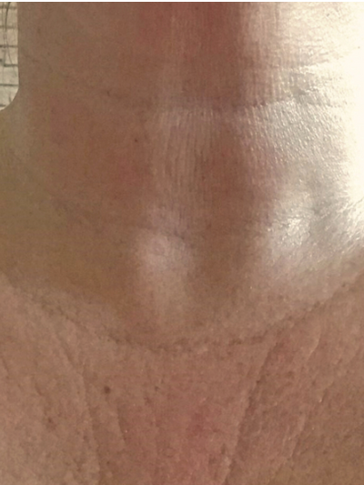 laser genesis 2 - Before