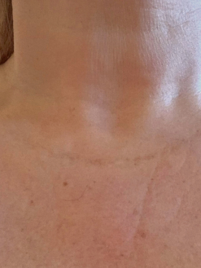 laser genesis 2 - After
