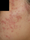 laser genesis 3 - Before