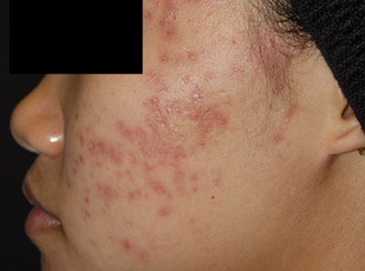laser genesis 3 - Before