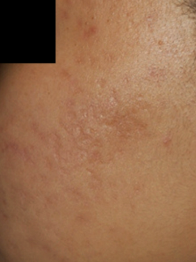 laser genesis 3 - After