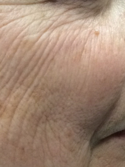 laser genesis - Before