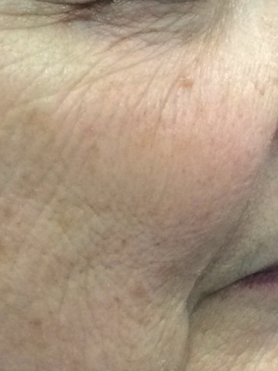 laser genesis - After