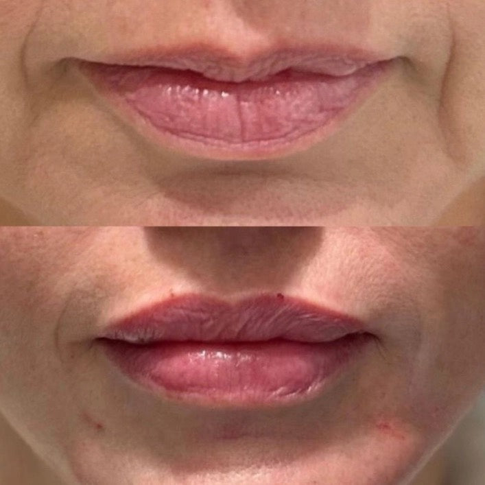 Lip Filler