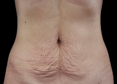 emtone 3 - Before