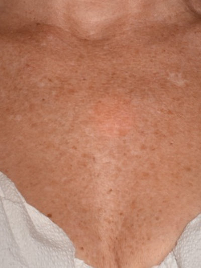 lasemd - Before