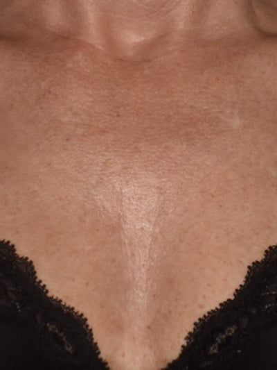lasemd - After