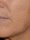lasemd3 - Before