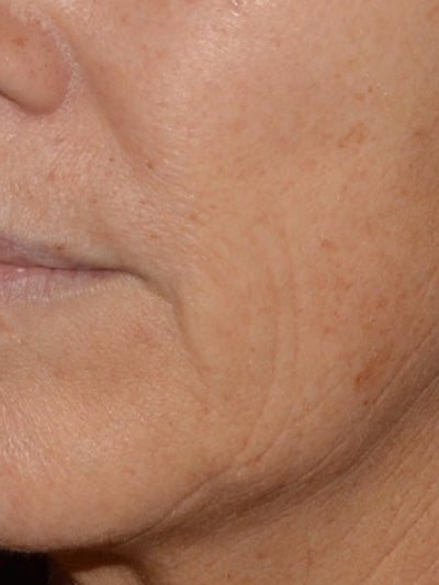 lasemd3 - Before