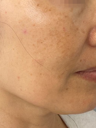 lasemd2 - Before