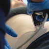 Morpheus8 Body Treatment