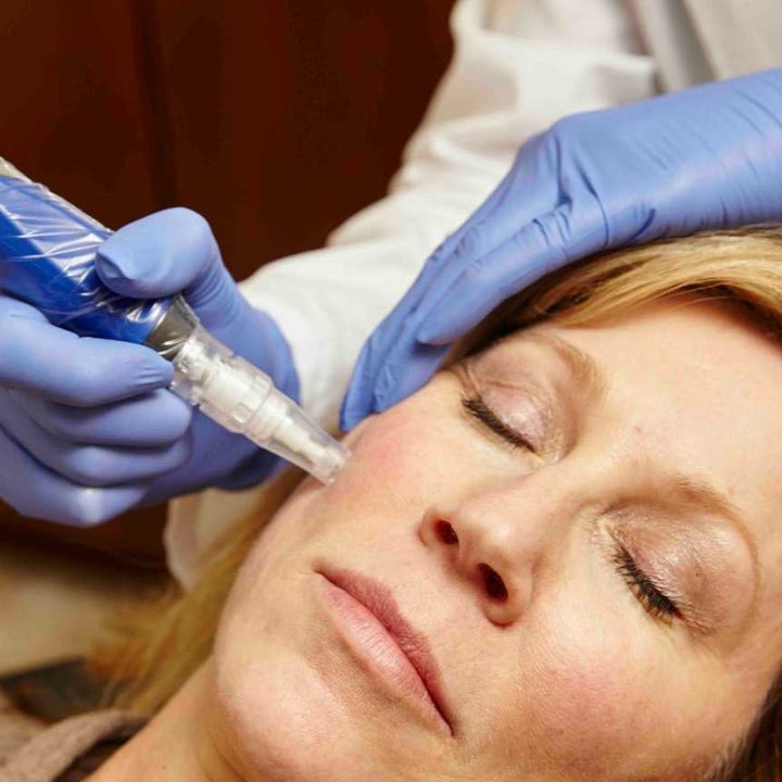 SkinPen® Microneedling January Sale Face + Neck Package