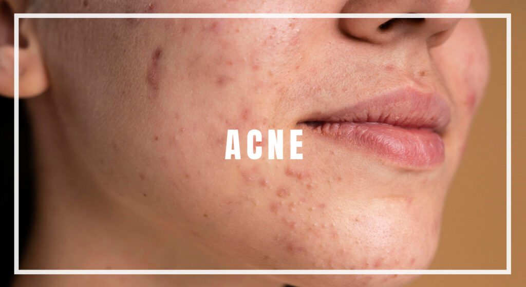 Acne