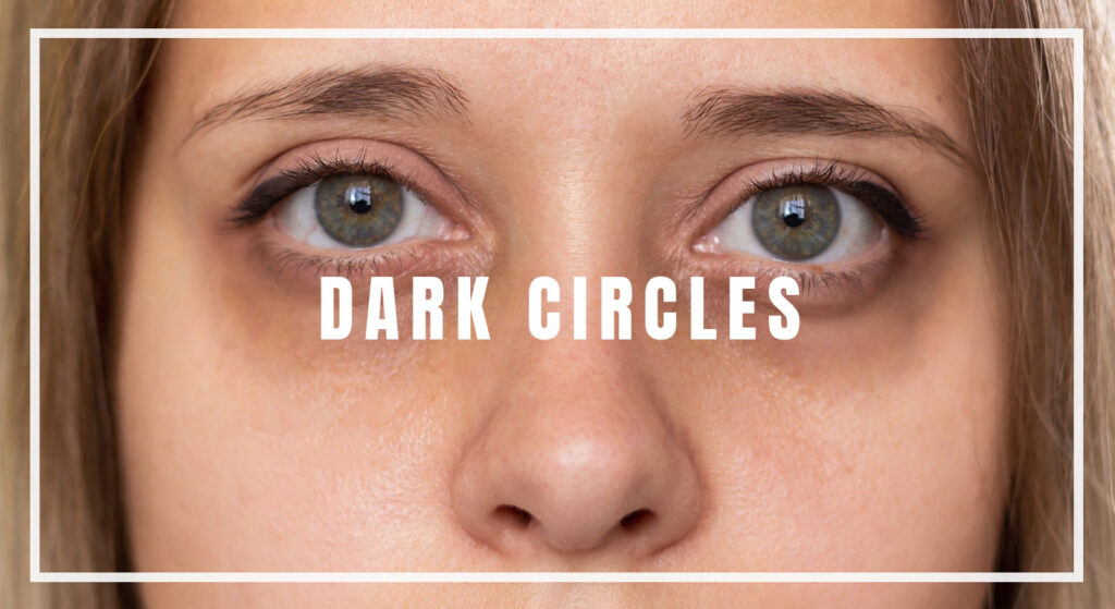 Dark-Circles