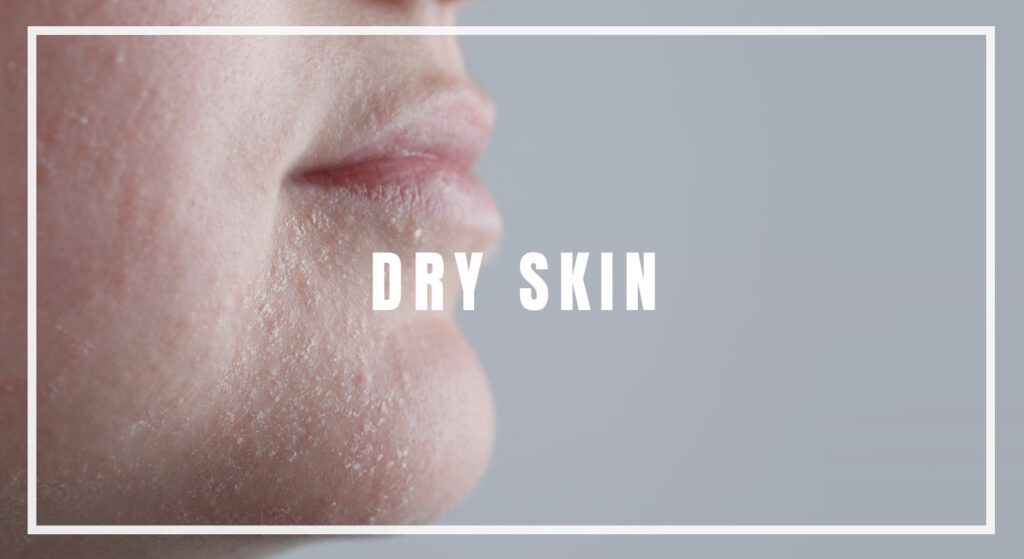 Dry Skin