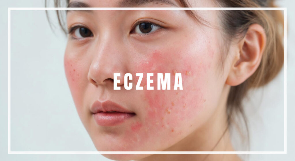 Eczema