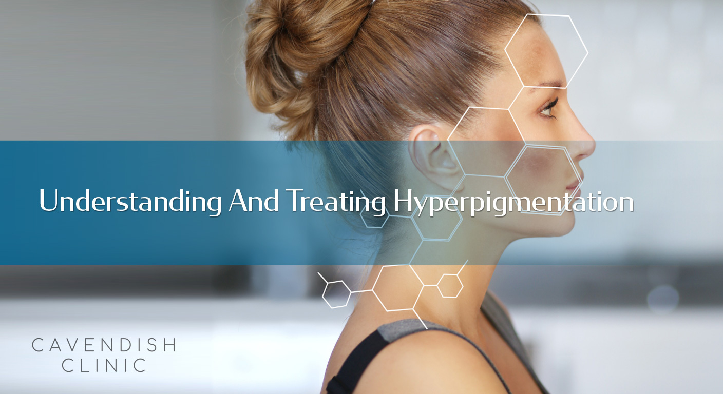 Understanding And Treating Hyperpigmentation