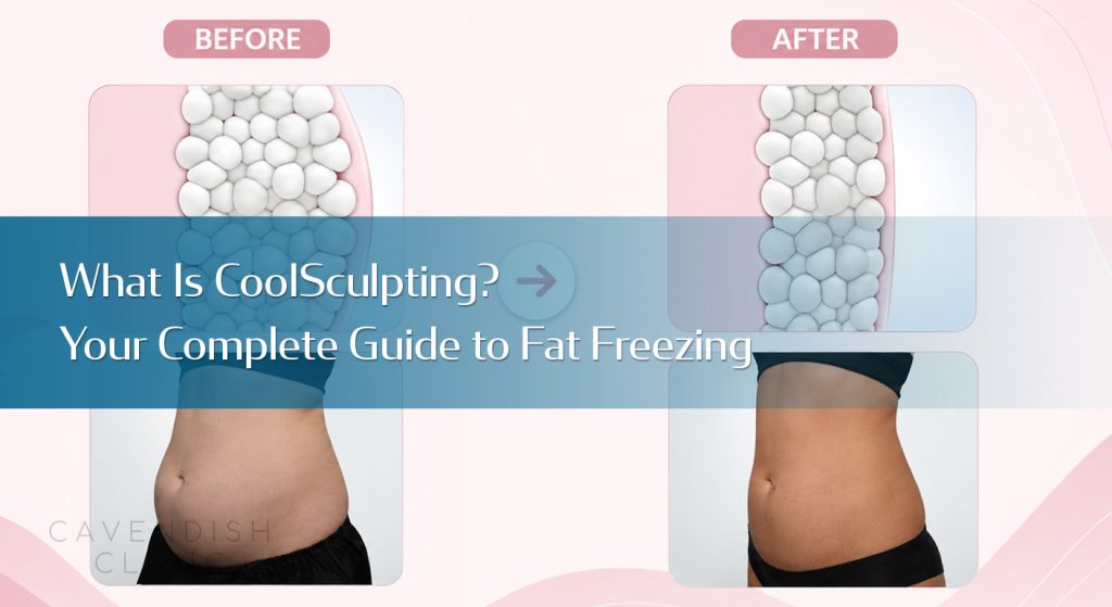What-Is-CoolSculpting