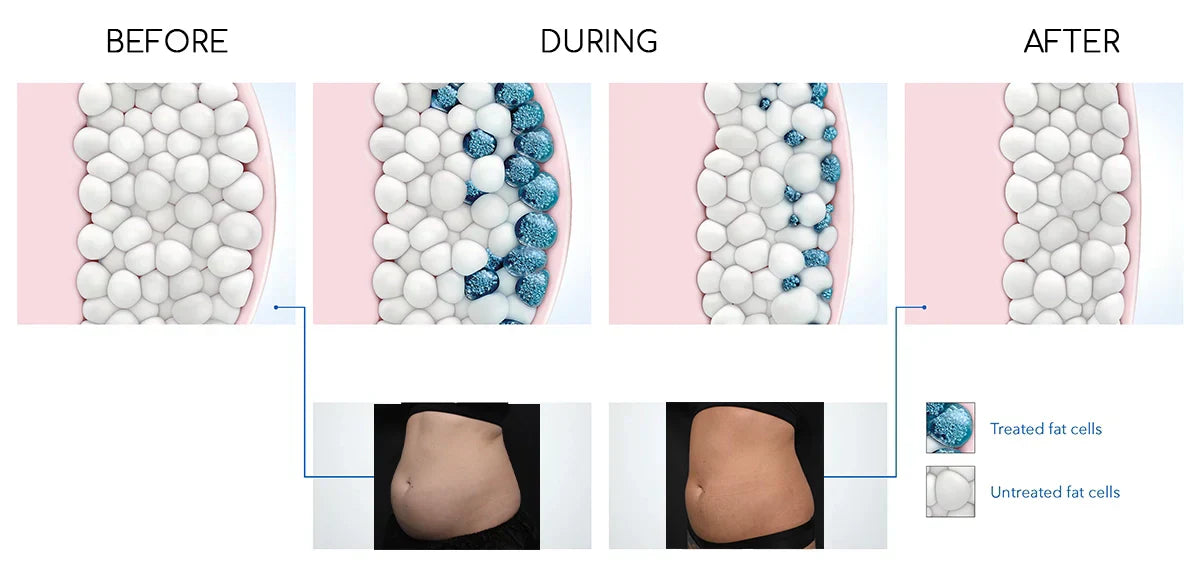 CoolSculpting