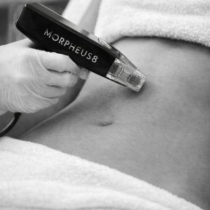 Morpheus8 – Full Face