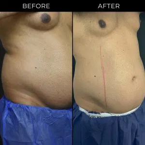 CoolSculpting Elite