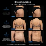 Coolsculpting