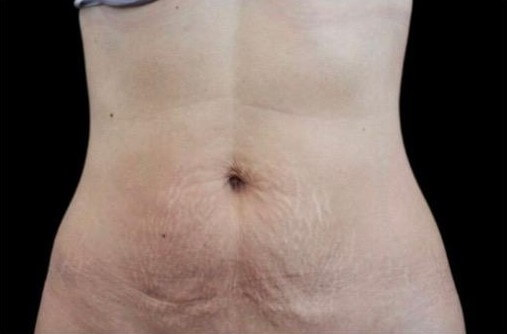 EMTONE ABDOMEN After