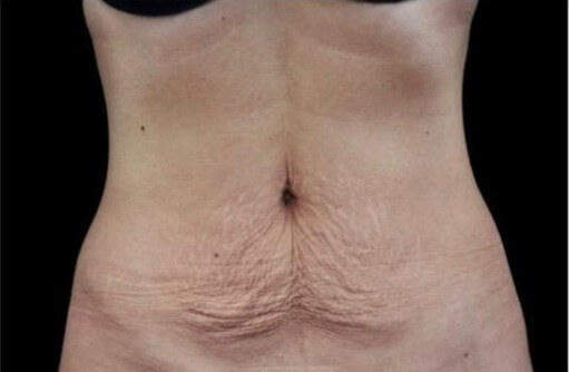 EMTONE ABDOMEN Before
