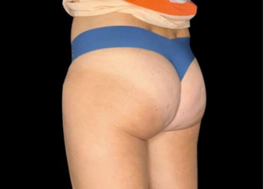 EMTONE GLUTES After