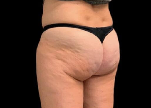 EMTONE GLUTES Before